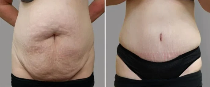 Which tummy tuck is right for me?  American Society of Plastic Surgeons