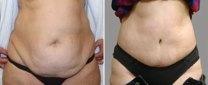 Muscle Tightening in Tummy Tuck Surgery - Explore Plastic Surgery