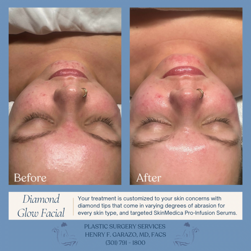 Before and after Diamond Glow facial