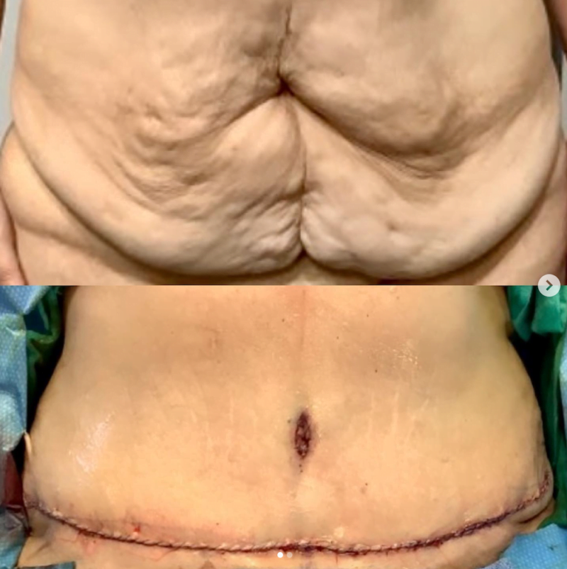 Before and after tummy tuck by Dr. Henry Garazo