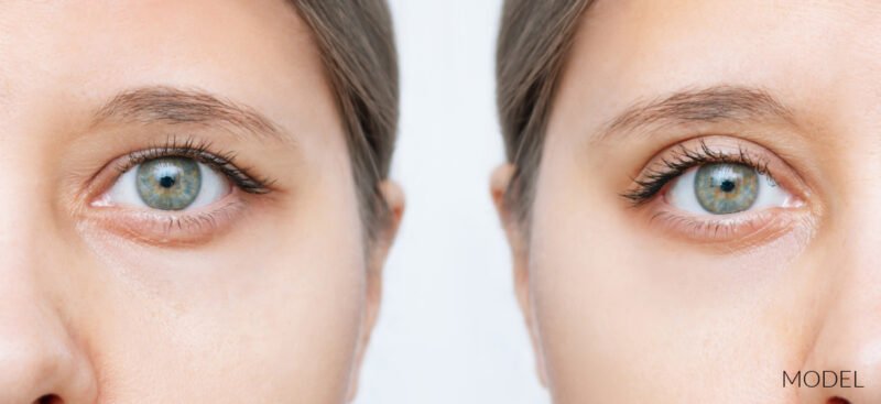 Before and after blepharoplasty surgery model image concept