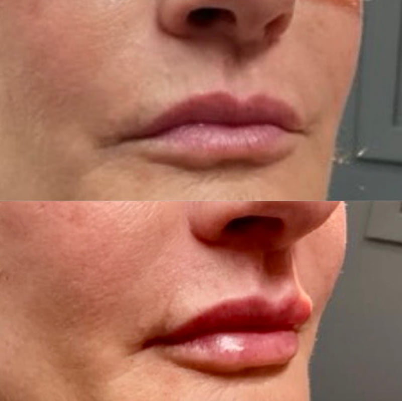 Real patient of Dr. Garazo shown before and after cheek filler with Juvederm lip filler injections at Hagerstown med spa