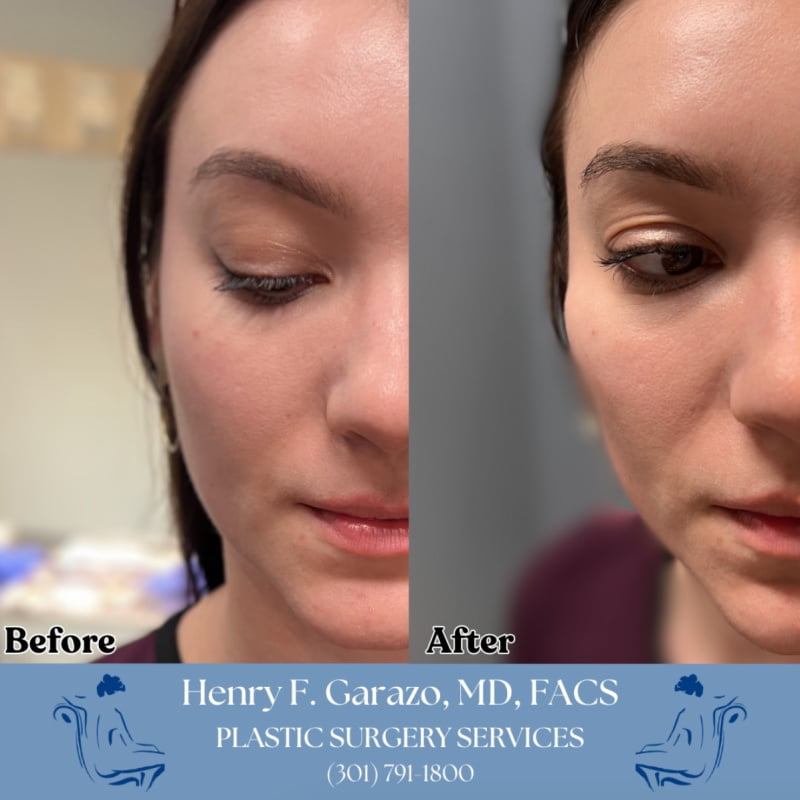 Real patient of Dr. Garazo shown before and after cheek filler with Juvederm Volluma injections at a Hagerstown med spa