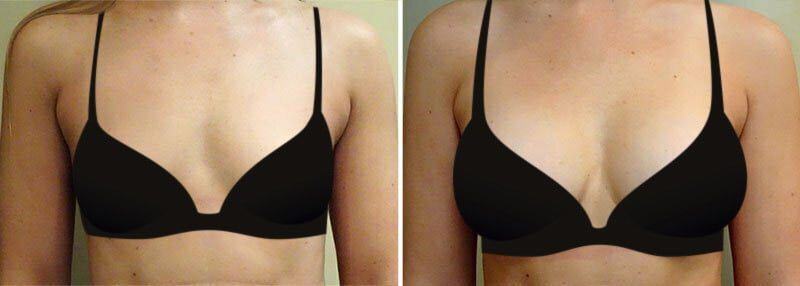 Woman before and after breast augmentation with Frederick plastic surgeon Dr. Garazo