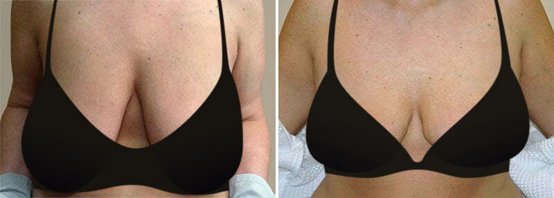 Woman before and after breast lift with Frederick plastic surgeon Dr. Garazo