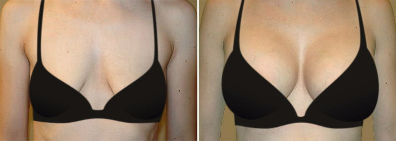 Woman before and after breast lift with augmentation with Frederick plastic surgeon Dr. Garazo