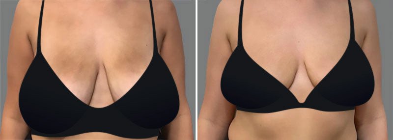 Woman before and after breast reduction with Frederick plastic surgeon Dr. Garazo