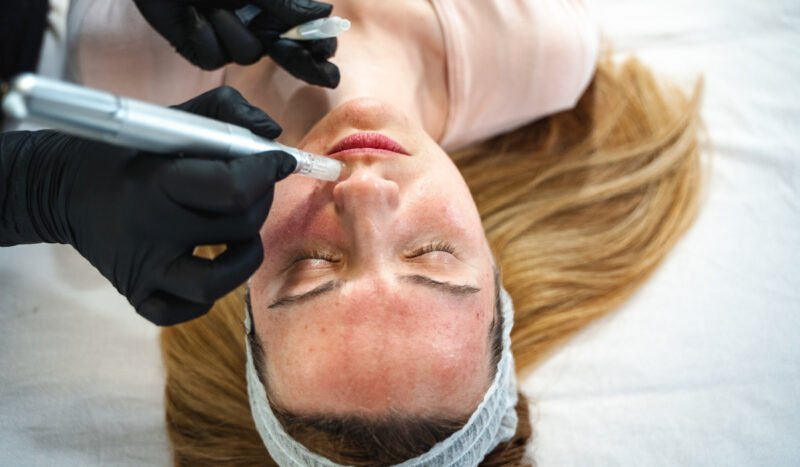 Woman getting a microneedling treatment to treat redness, scars, skin tone, and acne