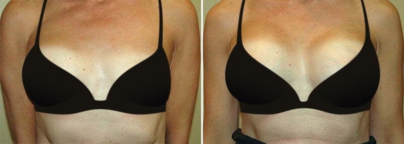 Woman before and after revision breast augmentation with Hagerstown plastic surgeon Dr. Garazo